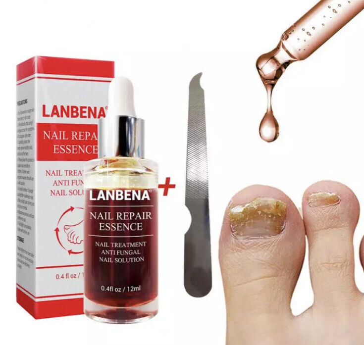 Lanbena Anti - Nagelpilz - Pilz Behandlung - Entfernung Von Nagelpilz (NEU)